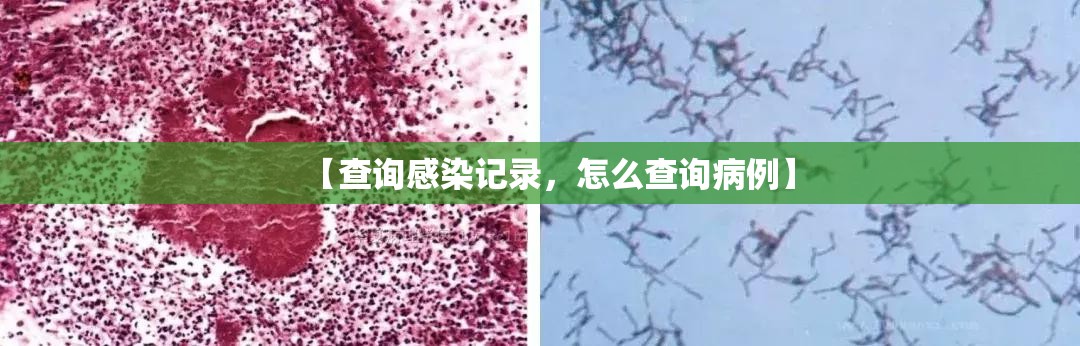 【查询感染记录，怎么查询病例】