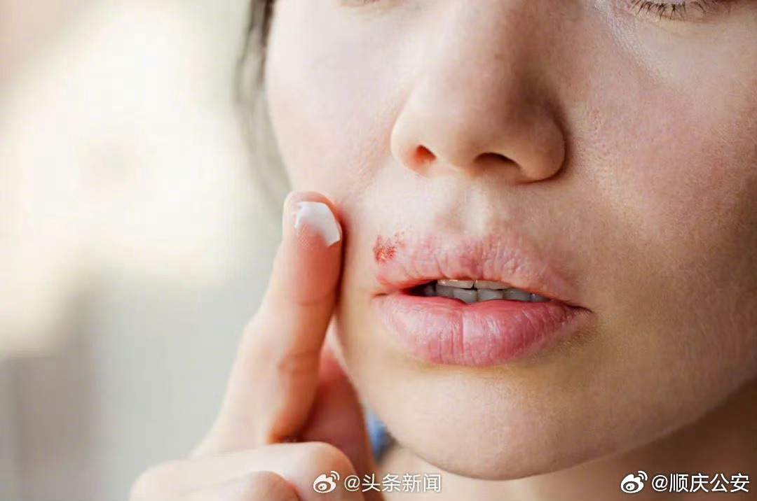 不戴口罩致20多人感染(不戴口罩就感染疱疹怎么办)