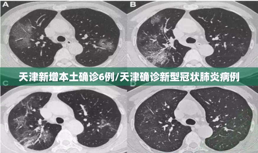 天津新增本土确诊6例/天津确诊新型冠状肺炎病例